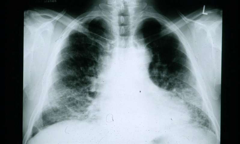 A chest xray of a patient with Idiopathic Pulmonary Fibrosis (IPF).