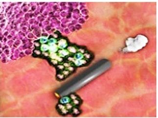 NANDOCS or medical nanorobots with microbullets