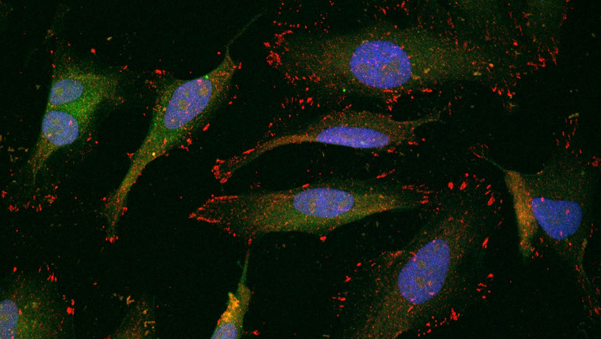 Cervical cancer cells metastasizing.