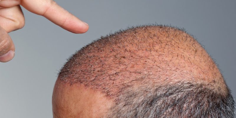 Why we go bald - the hallmarks of balding.